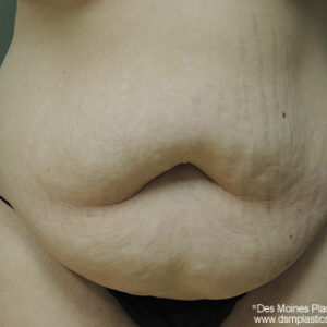 Tummy Tuck before and after photos