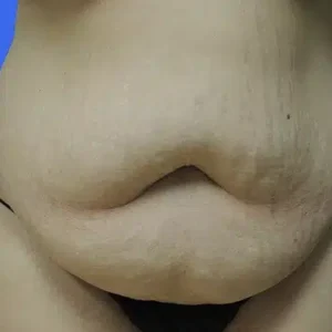 Tummy Tuck before and after photos Tummy Tuck before and after photos