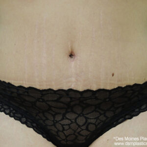 Tummy Tuck before and after photos