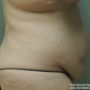 Tummy Tuck before and after photos