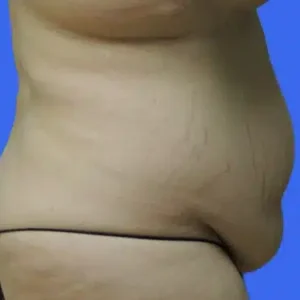 Tummy Tuck before and after photos Tummy Tuck before and after photos