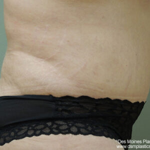 Tummy Tuck before and after photos