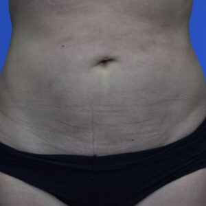 Liposuction before and after photos