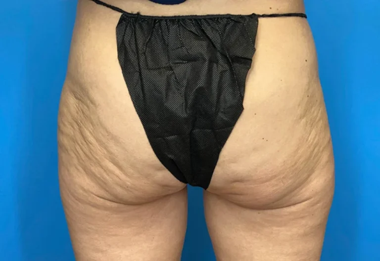 Aveli Cellulite Reduction: Before And After Gallery