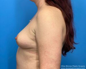 Breast Lift after left side view