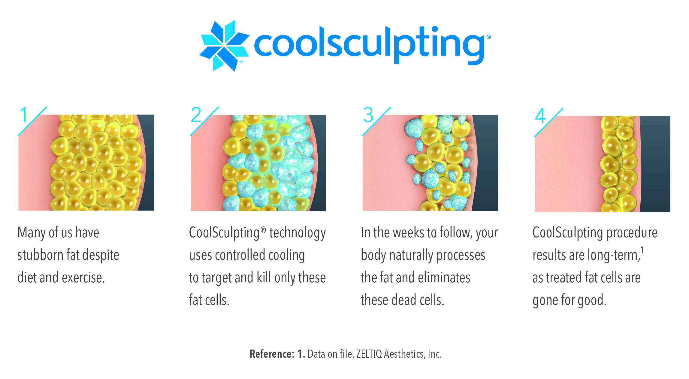 Just Freeze It! 2 Coolsculpting Infographic