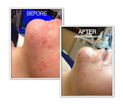 Water, Water Everywhere! 3 Hydrafacial Before And After Photo By Coachlight Clinic &Amp; Spa In Des Moines And Ankeny, Iowa