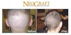Neograft Before And After Photo In Des Moines And Ankeny, Iowa