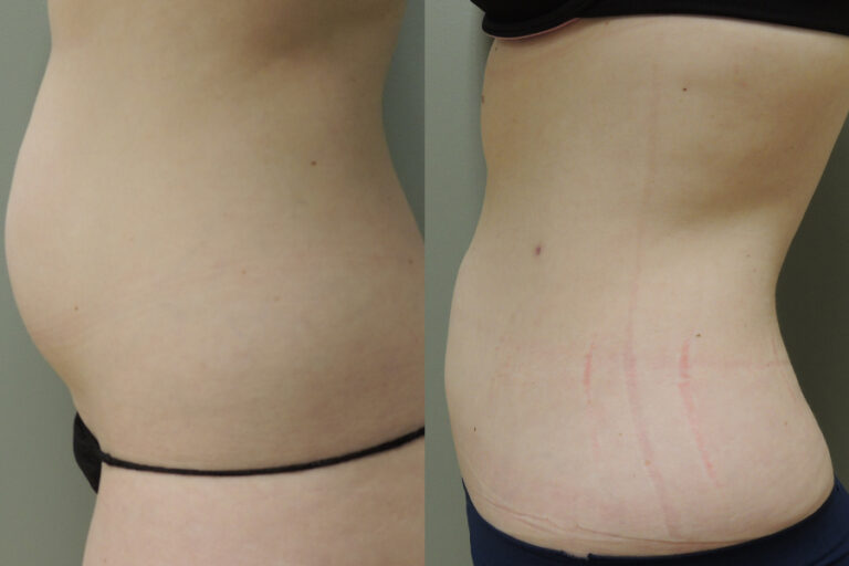 Lose The Unwanted Fat And Tighten Your Skin At The Same Time