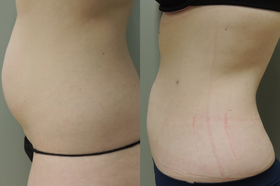Smartlipo Before And After Photo In Des Moines And Ankeny, Iowa