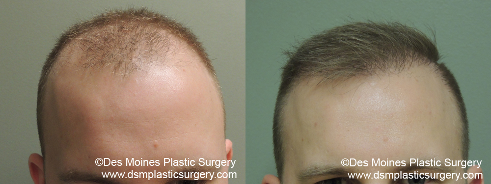 before and after neograft