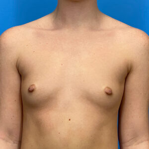 Breast Augmentation before and after photos