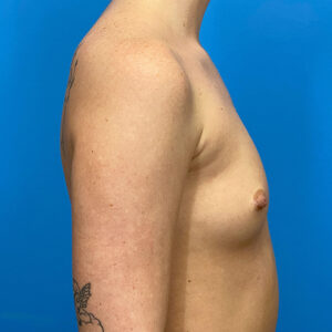Breast Augmentation before and after photos