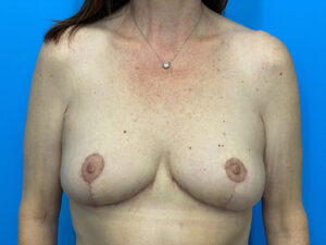 Breast Lift before and after photos