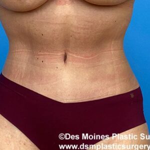 front view after tummy tuck