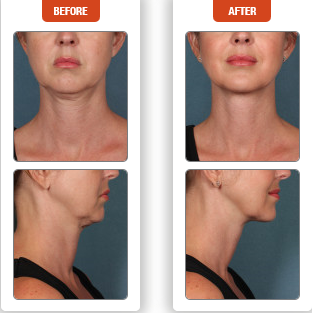 Introducing Kybella™ 3 Kybella Before And After Photo In Des Moines And Ankeny, Iowa