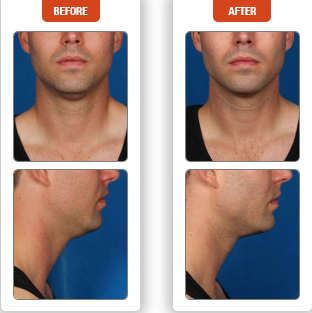Introducing Kybella™ 4 Kybella Before And After Photo In Des Moines And Ankeny, Iowa