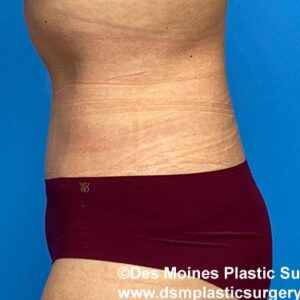 left side view after tummy tuck