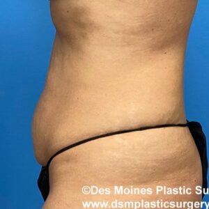 left side view before tummy tuck