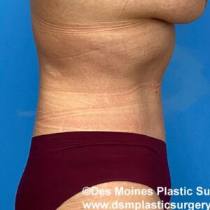 right side view after tummy tuck