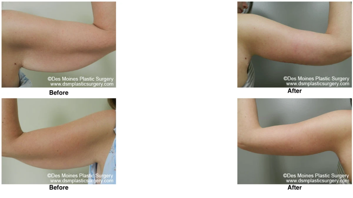 Arm Lift Before And After Performed By Dr David Robbins