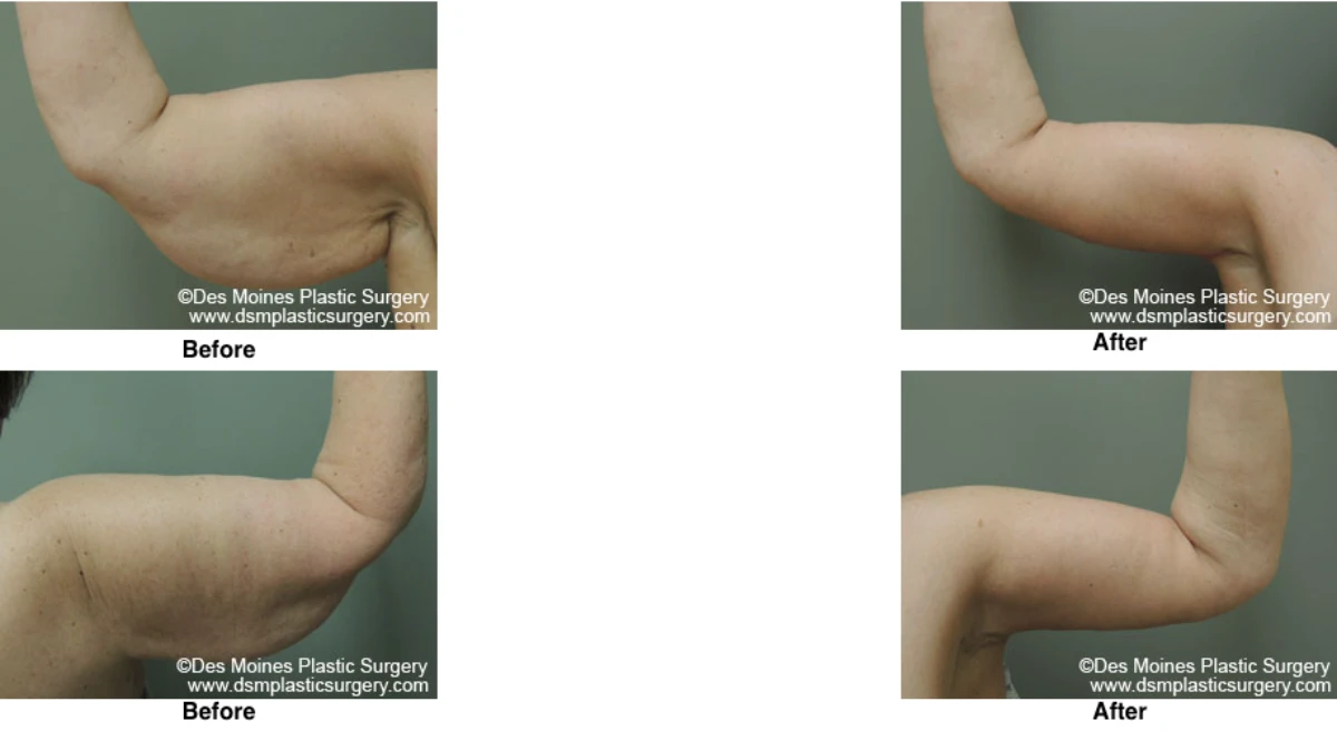 Arm Lift Before And After Performed By Dr David Robbins