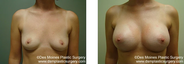 Breast Augmentation Before and After Gallery Photo Performed by Dr David Robbins