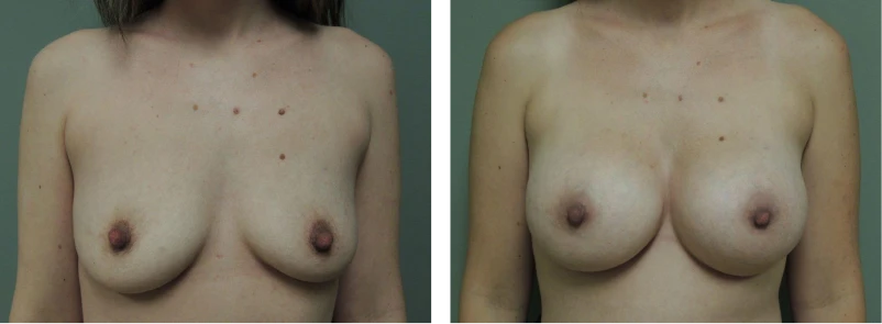 Breast Implant Exchange Before and After Gallery Photo Performed by Dr David Robbins