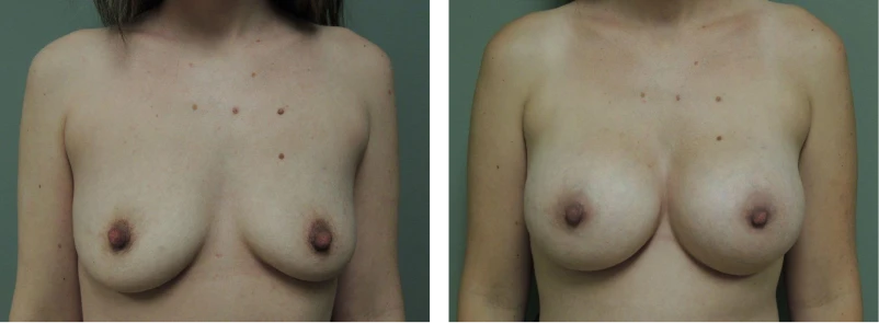 Breast Implant Exchange 3 Breast Implant Exchange Before And After Gallery Photo Performed By Dr David Robbins