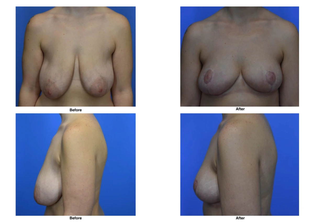 Breast Lift Before And After Performed By Dr David Robbins