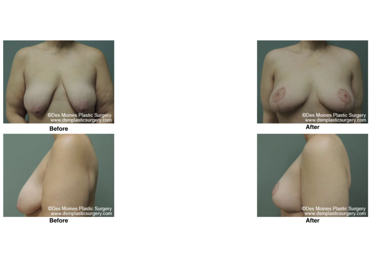 Breast Lift Before And After Performed By Dr David Robbins