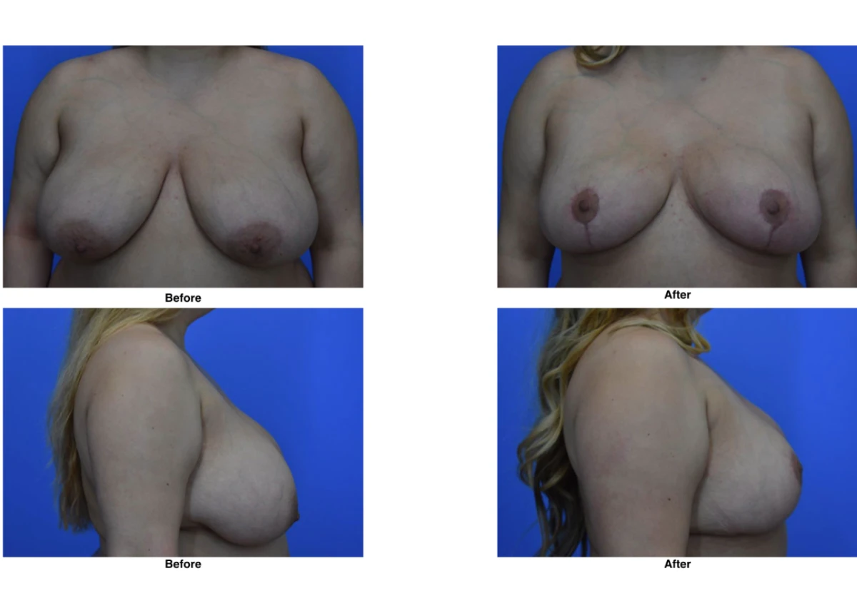 Breast Lift Before And After Performed By Dr David Robbins