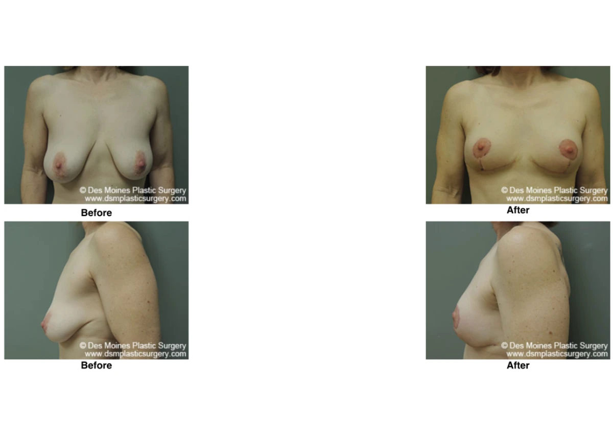 Breast Lift Before And After Performed By Dr David Robbins