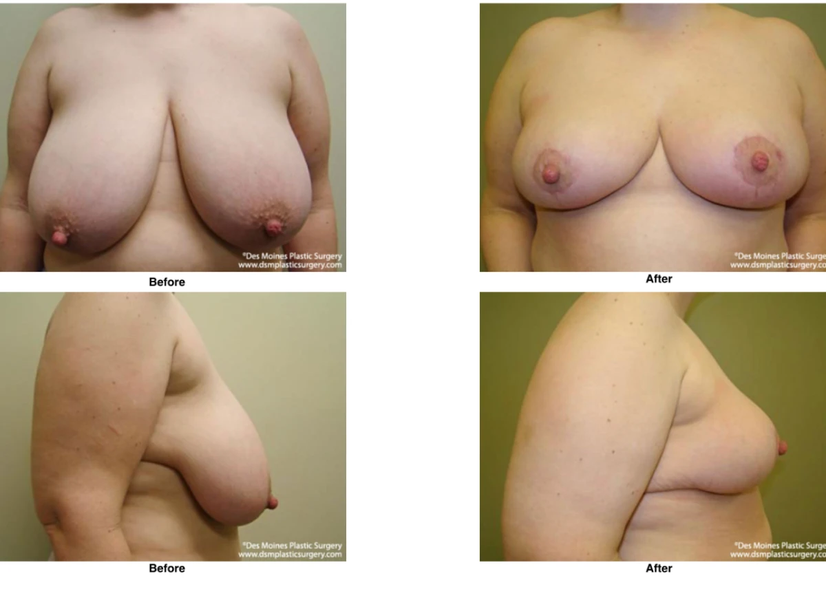 Breast Reduction Before And After Photo Performed By Dr David Robbins