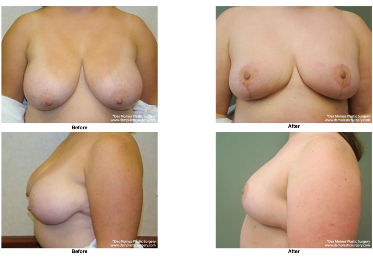 Breast Reduction Before And After Photo Performed By Dr David Robbins
