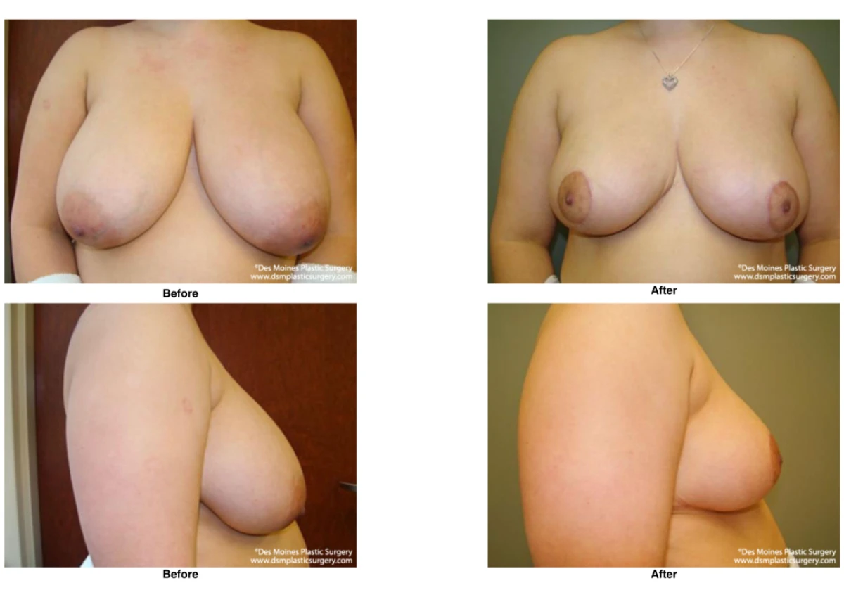 Breast Reduction Before And After Photo Performed By Dr David Robbins