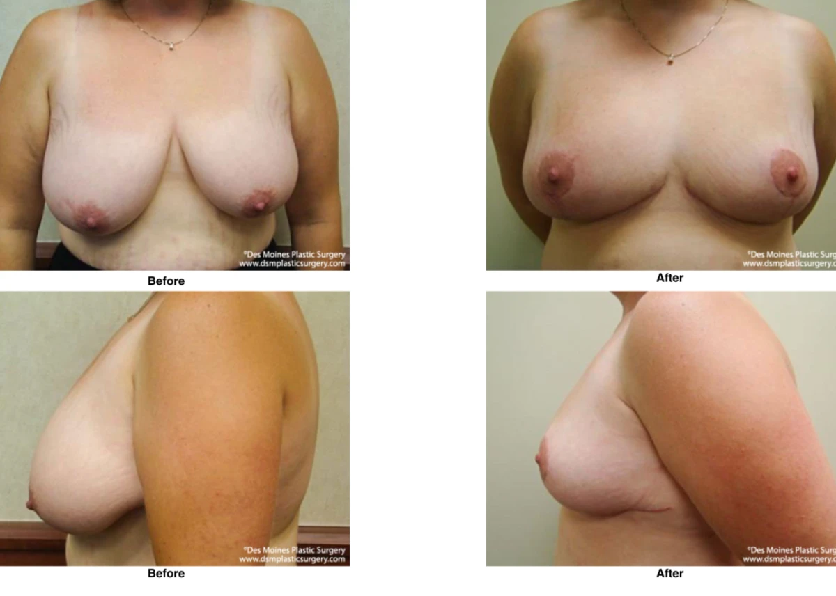 Breast Reduction Before And After Photo Performed By Dr David Robbins