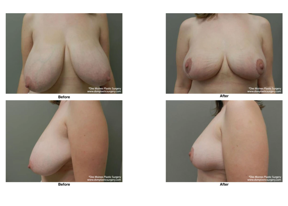 Breast Reduction Before And After Photo Performed By Dr David Robbins