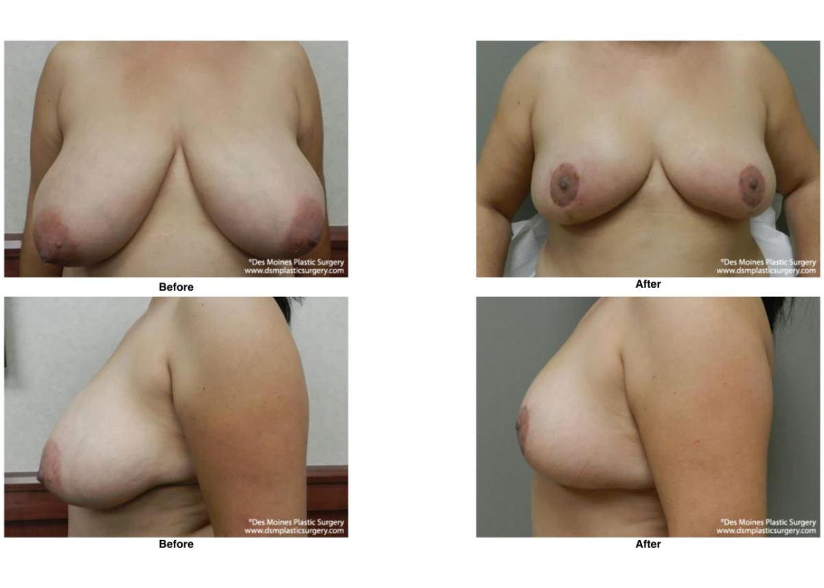Breast Reduction Before And After Photo Performed By Dr David Robbins