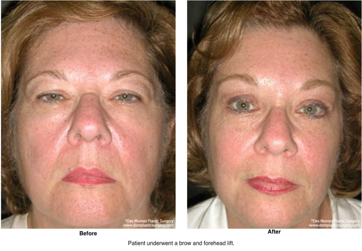 Brow Lift Before And After Photo By Dr David Robbins