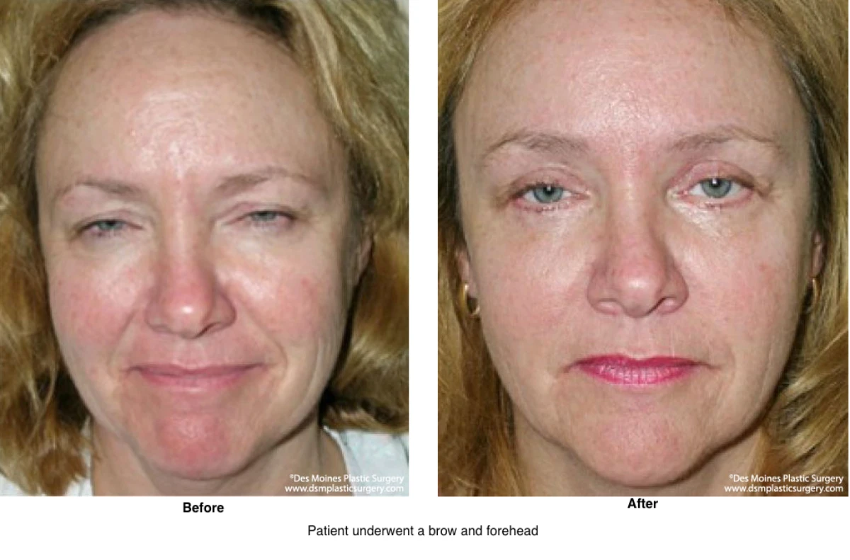 Brow Lift Before And After Photo By Dr David Robbins