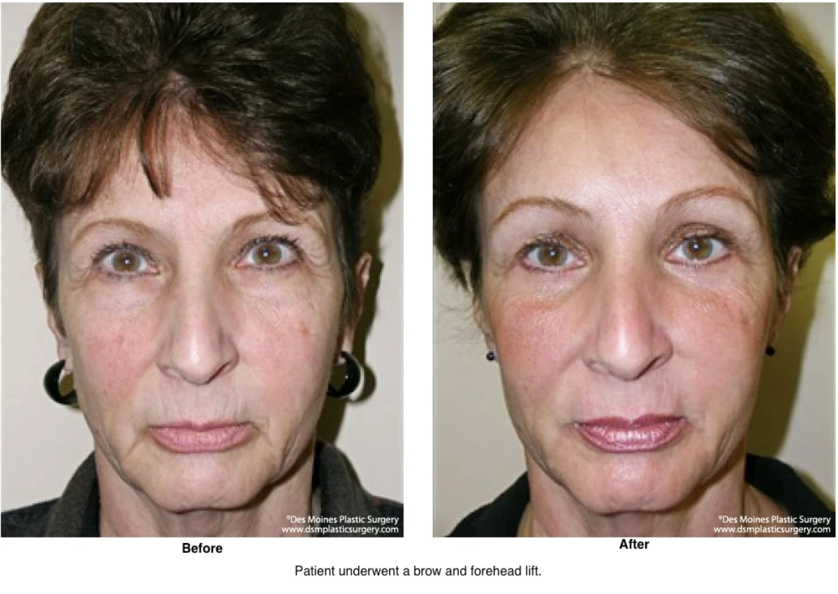 Brow Lift Before And After Photo By Dr David Robbins
