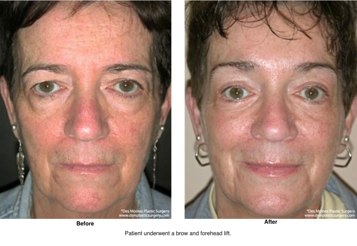 Brow Lift Before And After Photo By Dr David Robbins