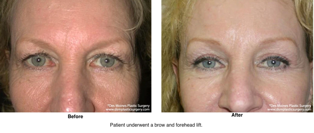 Brow Lift Before And After Photo By Dr David Robbins