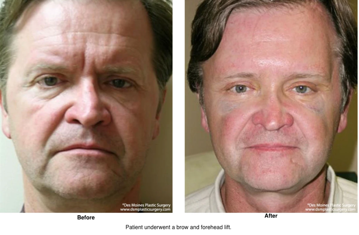 Brow Lift Before And After Photo By Dr David Robbins