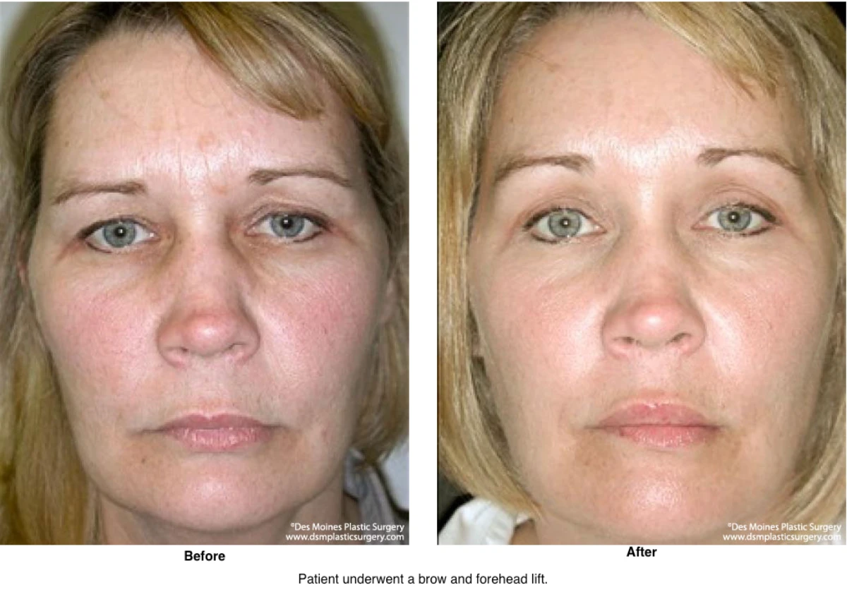 Brow Lift Before And After Photo By Dr David Robbins