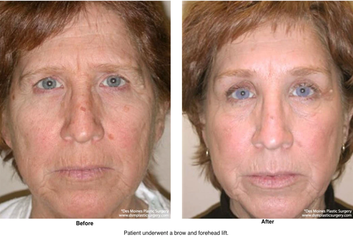 Brow Lift Before And After Photo By Dr David Robbins