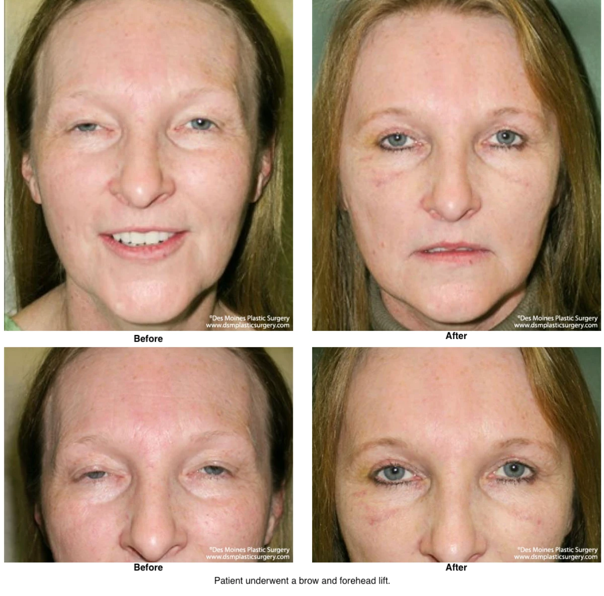 Brow Lift Before And After Photo By Dr David Robbins