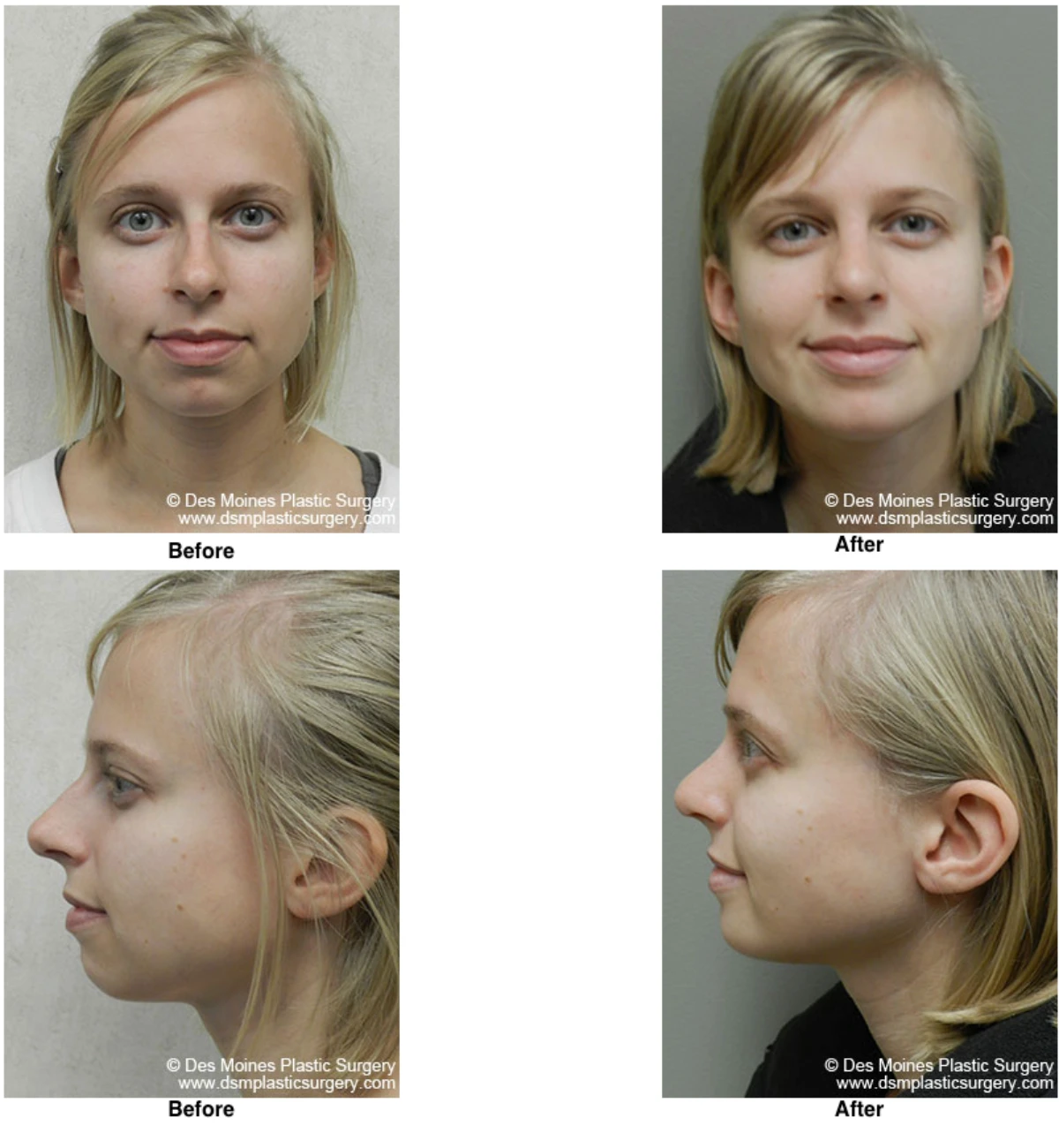 Chin Augmentation Before And After By Dr David Robbins
