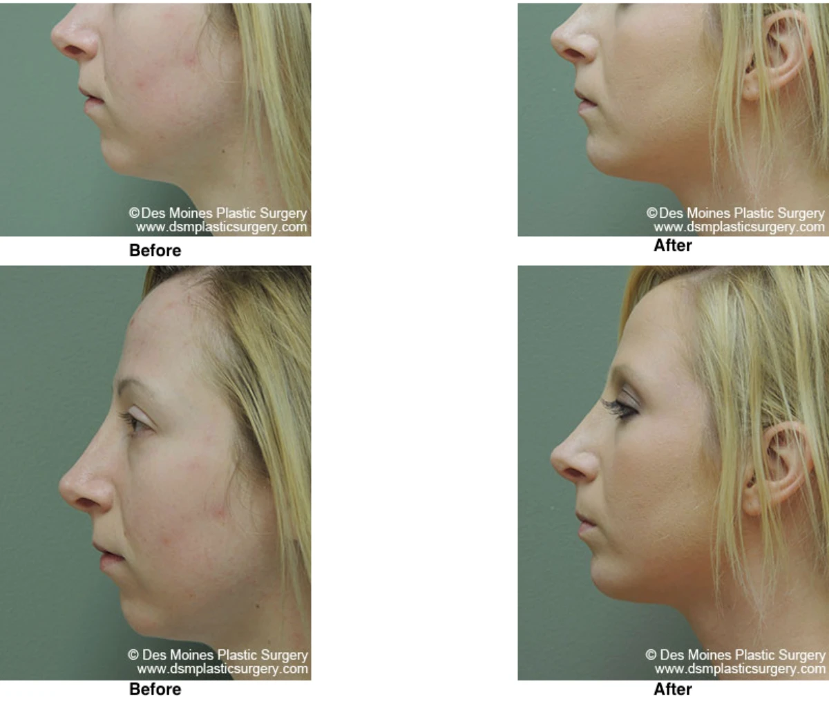 Chin Augmentation Before And After By Dr David Robbins